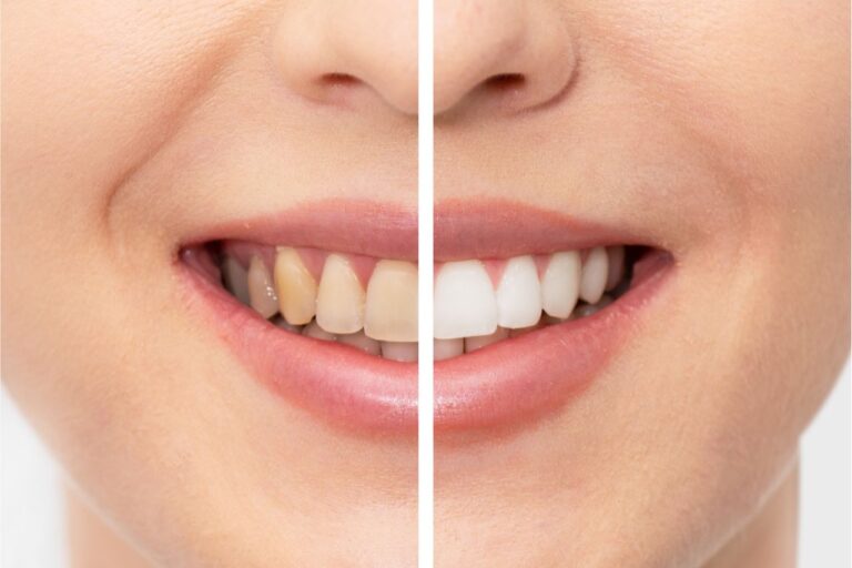 Dental Veneers and Teeth Whitening: Myths and Facts Uncovered