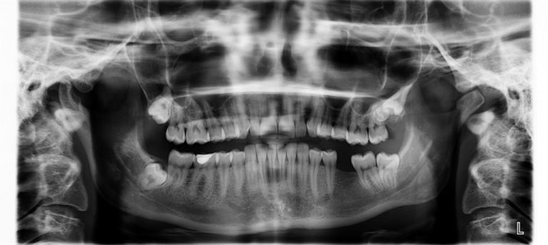 X-ray of mouth with missing tooth)