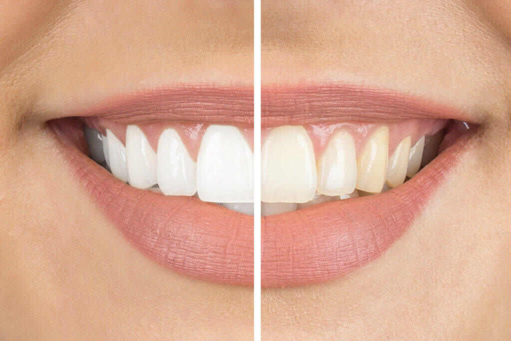 Easy Ways to Whiten Your Teeth
